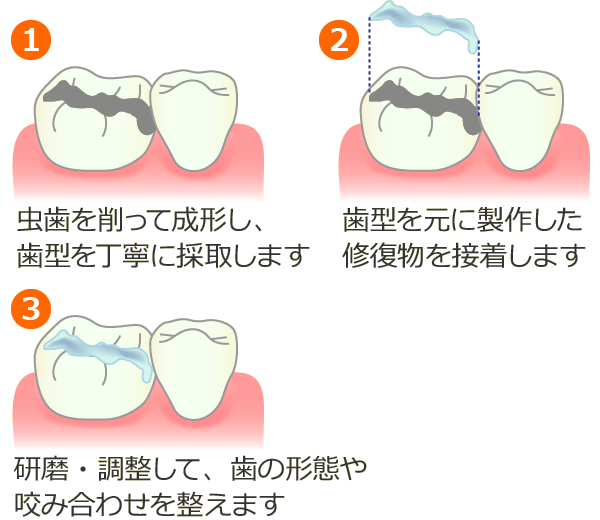 インレー修復法