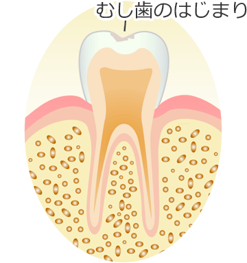 ＣＯ ： 初期のむし歯