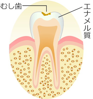 Ｃ１ ： エナメル質のむし歯
