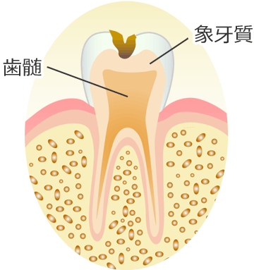 Ｃ２ ： 象牙質のむし歯