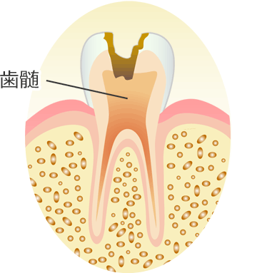 Ｃ３ ： 歯の神経（歯髄）のむし歯