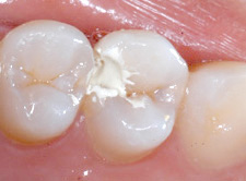 ドックベストセメント：虫歯の治療中