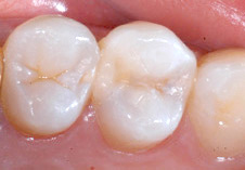 ドックベストセメント：虫歯の治療終了