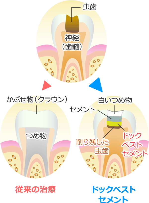 ドックベストセメントと従来の虫歯治療の比較