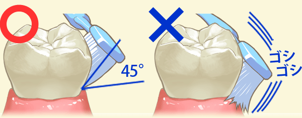歯周基本治療：例えば、歯の磨き方は