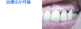 歯周病ＹＭ療法 治療６か月後