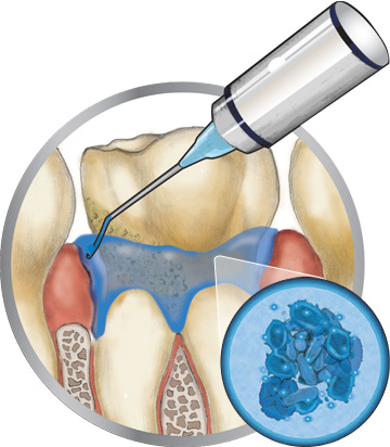 歯周病光線力学療法：バイオジェルの注入