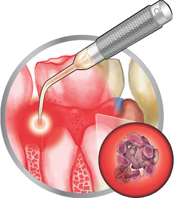 歯周病光線力学療法：レーザー照射