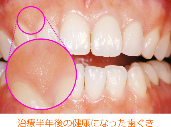 セラミックスクラウンの治療例：治療半年後の健康になった歯ぐき