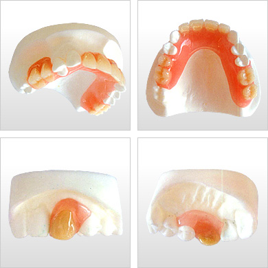 超ミラクルなノンクラスプ義歯！ 部分入れ歯・ミラクルフィット