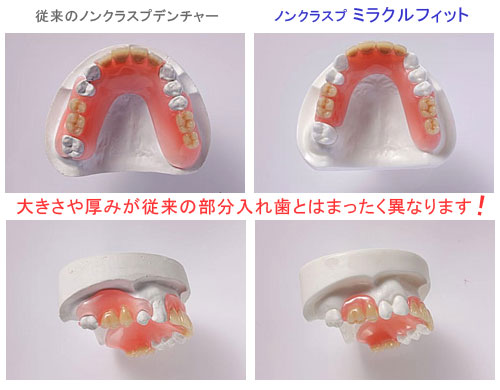 ミラクルフィットと従来のノンクラスプデンチャー