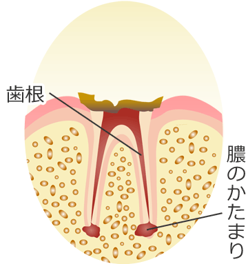Ｃ４ ： 末期のむし歯