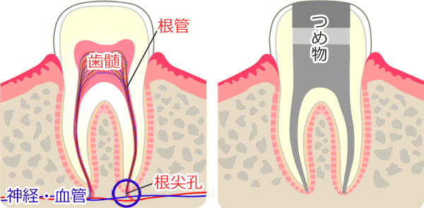 健康な歯と根管治療・抜髄処置後