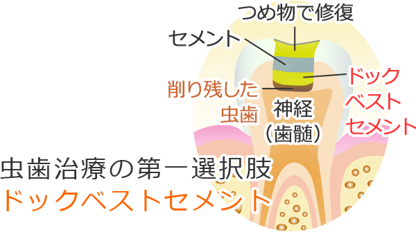 虫歯治療の第一選択肢“ドックベストセメント”