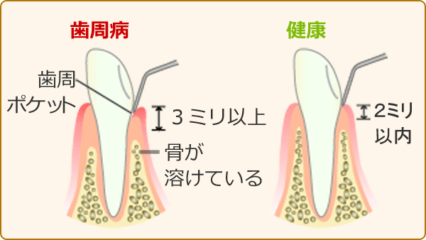 歯周基本検査：歯周ポケットの深度測定