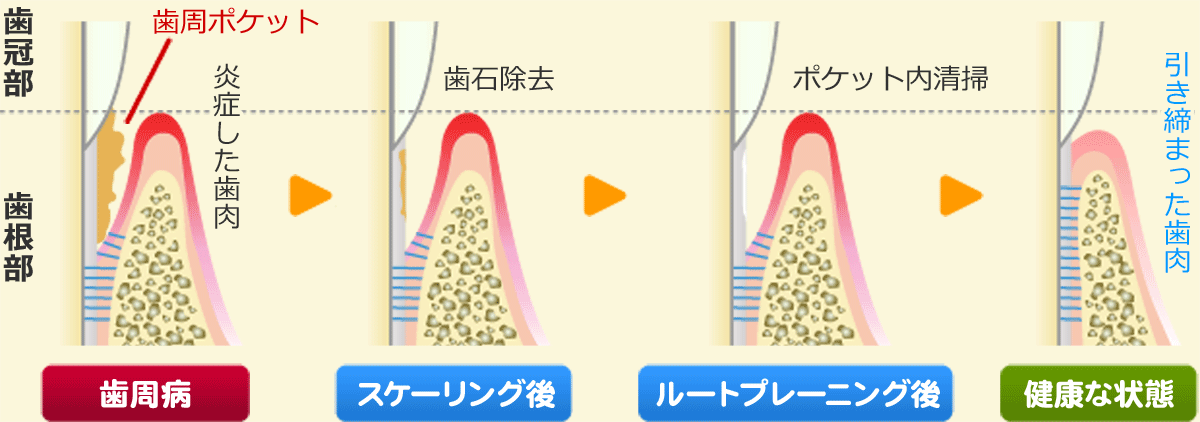 歯周基本治療：スケーリング・ルートプレーニング