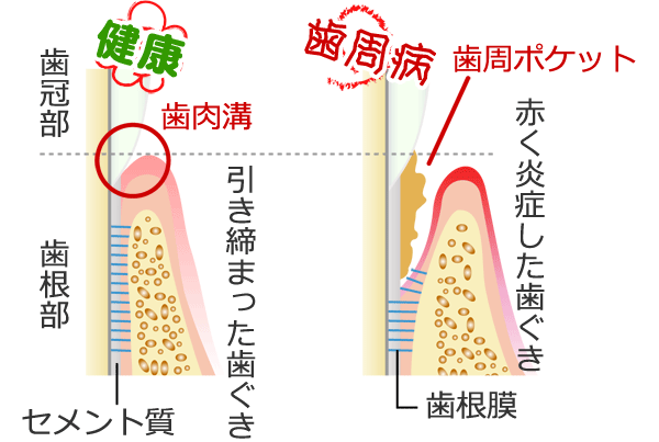 歯肉溝と歯周ポケット。あなたの歯ぐきはどっち？