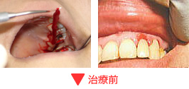 歯周病ＹＭ療法 治療前
