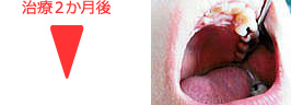 歯周病ＹＭ療法 治療２か月後