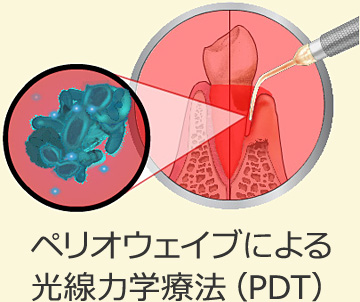 ペリオウェイブによる光線力学療法（PDT）の歯周病治療イメージ