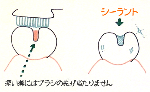 大切なお子様の奥歯を虫歯から守る予防処置