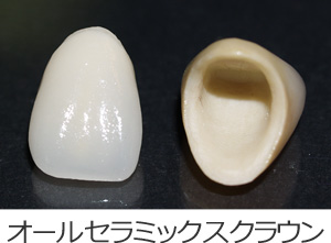 オールセラミックスクラウン