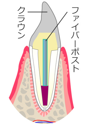 ファイバーポスト