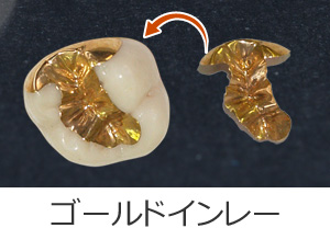 ゴールドインレー