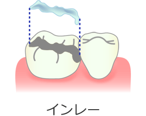 セラミックスインレー