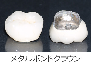 メタルボンドクラウン